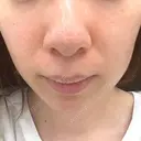 ヴェルヴェットスキン 東京シンデレラ美容外科 大宮院 BEFORE サムネイル用