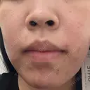 ポテンツァ 渋谷美容外科クリニック 横浜院 BEFORE サムネイル用