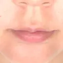ヒアルロン酸注入（唇） / ボトックス（口角） ルラ美容クリニック 札幌本院 BEFORE サムネイル用