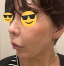 ヒアルロン酸注入（鼻） プリモ麻布十番クリニック BEFORE サムネイル用