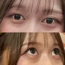 下まぶたの脂肪取り APOLLO BEAUTY CLINIC BEFORE サムネイル用