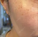 エレクトロポレーション / 光治療（フォトフェイシャルなど） 若倉診療所 BEFORE サムネイル用