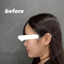 脂肪吸引（顔） ネビュラクリニック 京都院 BEFORE サムネイル用