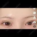 クマ治療 / 目尻切開 / タレ目形成・グラマラスライン（切開） R Beauty CLINIC 銀座院 BEFORE サムネイル用
