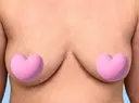 その他（胸） WOM CLINIC GINZA （ワム クリニック ギンザ） BEFORE サムネイル用