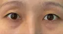 クマ治療 / 脂肪注入（目の下） 湘南美容クリニック 千葉センシティ院 BEFORE サムネイル用