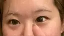 ヒアルロン酸注入（涙袋） ファイヤークリニック 渋谷院 BEFORE サムネイル用