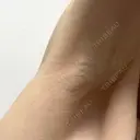 ワキ汗治療（切開） 石倉クリニック 水戸院 BEFORE サムネイル用