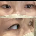 ヒアルロン酸注入（涙袋） ファイヤークリニック 渋谷院 BEFORE サムネイル用