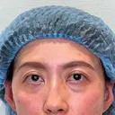 下まぶたの脂肪取り APOLLO BEAUTY CLINIC BEFORE サムネイル用