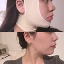 その他（鼻） / バッカルファット除去 / 鼻尖形成（非切開） / 小鼻縮小（非切開） / ボトックス（エラ・小顔） / ヒアルロン酸注入（唇） / ボトックス（肩） TCB東京中央美容外科 広島院 BEFORE サムネイル用