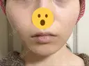 骨削り（頬） 湘南美容クリニック 新橋銀座口院 BEFORE サムネイル用