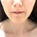 ボトックス（あご） / ヒアルロン酸注入（鼻翼基部） / その他（口元） ルラ美容クリニック 東京駅前院 BEFORE サムネイル用