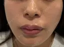 ボトックス（エラ・小顔） / ヒアルロン酸注入（鼻翼基部） R Beauty CLINIC 名古屋院 BEFORE サムネイル用