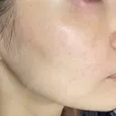 その他（肌） / ポテンツァ オラクル美容皮膚科 大阪梅田院 BEFORE サムネイル用