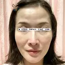 脂肪吸引（脚） / 脂肪吸引（お尻） / 脂肪注入（輪郭） Mods Clinic（モッズクリニック） 名古屋院 BEFORE サムネイル用