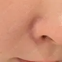 ピーリング（ハリ・ツヤ） Re:anne clinic 銀座 【リアンクリニック銀座】 BEFORE サムネイル用