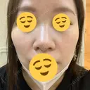 ヒアルロン酸注入（頬） 渋谷美容外科クリニック 渋谷院 BEFORE サムネイル用