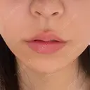 人中短縮 / ボトックス（人中） eクリニック 金沢本院 BEFORE サムネイル用