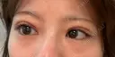 下まぶたの脂肪取り APOLLO BEAUTY CLINIC BEFORE サムネイル用
