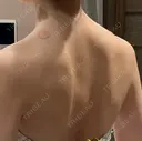 ボトックス（肩） 共立美容外科 浜松院 BEFORE サムネイル用
