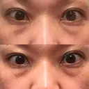 下まぶたたるみ取り セオリークリニック BEFORE サムネイル用