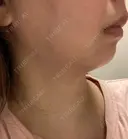 ハイフ（顔） しらさぎ形成クリニック 徳島院 BEFORE サムネイル用