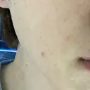 ピーリング（ニキビ・毛穴） Tokyo Tensei Clinic 銀座院 BEFORE サムネイル用