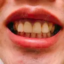 セラミック 東京美容外科 赤坂院 BEFORE サムネイル用