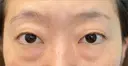 クマ治療 / 下まぶたたるみ取り / 下まぶたの脂肪取り / 脂肪注入（目の下） 湘南美容クリニック 千葉センシティ院 BEFORE サムネイル用