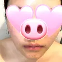 ボトックス（エラ・小顔） / ボトックス（口角） ビューティースキンクリニック 池袋院 BEFORE サムネイル用