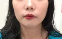 糸リフト PRISM Beauty Clinic 町田院 BEFORE サムネイル用