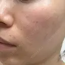 エレクトロポレーション / フォトシルクプラス もとび美容外科クリニック 新宿院 BEFORE サムネイル用