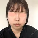 脂肪吸引（顔） R Beauty CLINIC 名古屋院 BEFORE サムネイル用