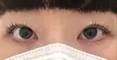 二重埋没 / ボトックス（エラ・小顔） / ボトックス（肩） THE FIRST CLINIC 多摩センター院 BEFORE サムネイル用