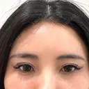 ヒアルロン酸注入（涙袋） シェリークリニック 新宿本院 BEFORE サムネイル用