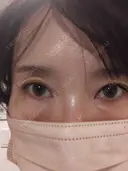 その他（目元） スマートスキンクリニック 神保町院 BEFORE サムネイル用