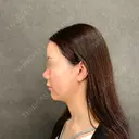 糸リフト / 脂肪吸引（顔） ネビュラクリニック 京都院 BEFORE サムネイル用