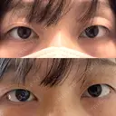 二重埋没 BELINDA CLINIC（ベリンダクリニック）新宿院 BEFORE サムネイル用