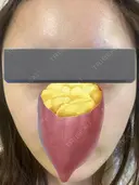 その他（肌） / ピーリング（ハリ・ツヤ） 東京シンデレラ美容外科 大宮院 BEFORE サムネイル用