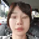 ボトックス（エラ・小顔） 品川美容外科 仙台院 BEFORE サムネイル用