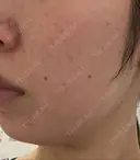 RF（高周波）たるみ治療 東京美容医療クリニック 池袋院 BEFORE サムネイル用