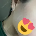 医療脱毛（顔） Lumiera Clinic BEFORE サムネイル用
