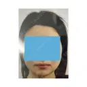 切開リフト 東京エビスクリニック BEFORE サムネイル用