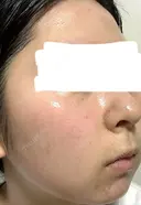 水光注射（ハリ・美肌） ARTE BEAUTY CLINIC BEFORE サムネイル用
