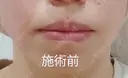 ヒアルロン酸注入（唇） Tokyo Tensei Clinic 新宿院 BEFORE サムネイル用