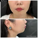 ボトックス（あご） / ヒアルロン酸注入（あご） ルラ美容クリニック 町田院 BEFORE サムネイル用