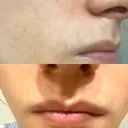 医療脱毛（顔） Lumiera Clinic BEFORE サムネイル用