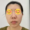 ポテンツァ DAILY SKIN CLINIC 福岡院 BEFORE サムネイル用