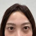 クマ治療 / スネコス PRISM Beauty Clinic 町田院 BEFORE サムネイル用